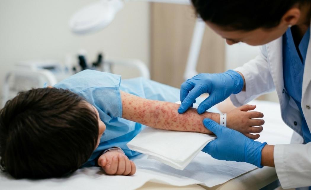 Meski Kasus Campak Turun Tajam, Kemenkes Ingatkan Tim Medis Tidak Abaikan Gejala Penyakit