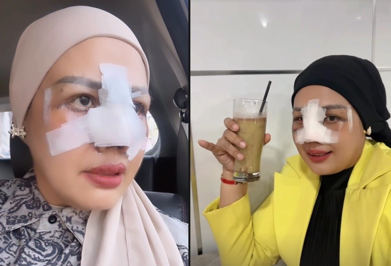 Elly Sugigi Pamer Operasi Hidung, Ungkap Ingin Hidup seperti Manusia Sempurna