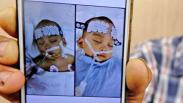 Bayi Kembar Siam di Sumatera Utara Berhasil Dipisahkan, Begini Kondisinya