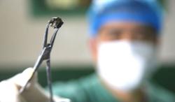 Ada Peluru Bersarang di Kaki Perempuan Ini Selama 72 Tahun