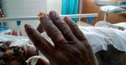 Diduga Jadi Korban Malapraktik, Kulit Pasien RSUP Adam Malik Melepuh