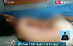 Tersiram Air Mendidih, Tubuh Bocah Ini Melepuh dan Mengalami Luka Bakar
