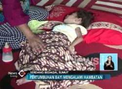 Berat Hanya 6 Kg, Balita 4 Tahun di Sumut Alami Kekurangan Gizi