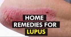 Mengenal Lupus, Penyakit Paling Sering Menyerang Perempuan