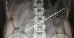 Gara-Gara Kalah Taruhan, Pria Ini Terpaksa Telan Batang Besi 20 Cm