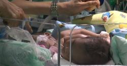 Kritis, Bayi Kembar Siam Dempet Dada Perut Asal Ternate Akan Dioperasi