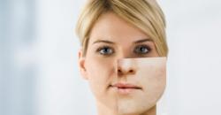 Ladies Wajib Tahu, 4 Cara Ampuh Hilangkan Bekas Jerawat