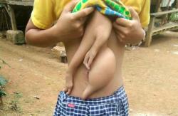 Tangan Menjulur dari Dada Remaja Ini, Ternyata Saudara Kembarnya