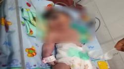 Bertahan Hidup 7 Jam, Bayi Mata Satu Tanpa Hidung di Madina Meninggal
