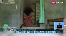 Wajahnya Digerogoti Tumor, Gadis asal Lamongan Bernapas Lewat Mulut