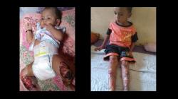 2 Bocah di Madina Terkena Toksoplasma, Kulitnya Melepuh dan Terkelupas