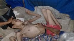 Derita Cerebral Palsy Sejak Bayi, Tubuh Pemuda Ini Kurus dan Lumpuh  