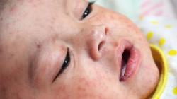 Wabah Virus Campak Landa Manila, Nyawa 2 Juta Anak Terancam