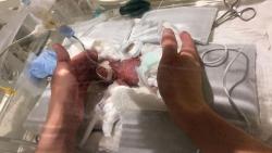 Rekor, Bayi Terkecil Seukuran Telapak Tangan Lahir di Jepang