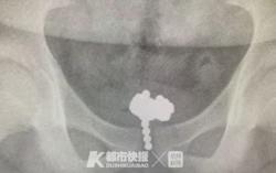 Lagi, Bocah Dioperasi karena Masukkan 70 Bola Magnet ke Alat Kelamin