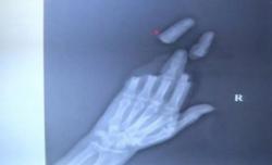 3 Jari Pria Ini Terpotong Benang saat Main Layang-Layang