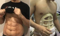 RS di Thailand Ini Bisa Sulap Pria Gemuk Jadi Six Pack dalam Sekejap