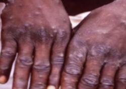 Dinkes DKI Pastikan Belum Ada Warga Terjangkit Penyakit Cacar Monyet