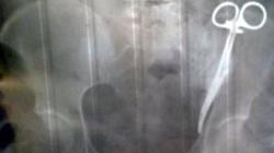 Gunting Tertinggal di Perut Perempuan Ini Selama 23 Tahun, kok Bisa?