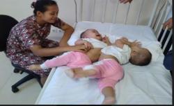 Bayi Kembar Siam Adam dan Malik Akan Jalani Operasi Pemisahan di RSUP Medan