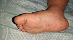 Warga Medan Geger dengan Wabah Virus Flu Singapura