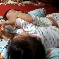 Kondisi Melemah, Bayi Kembar Siam Dempet Perut Dirawat Intensif di RSUP Adam Malik Medan