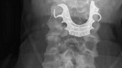 Bikin Ngilu, Gigi Palsu Nyangkut di Tenggorokan Pria Ini