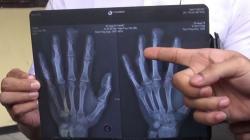 Heboh Bos Kafe Hantam Jari Karyawan Pakai Palu 5 Kali hingga Remuk di Malang