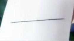 Ngeri, Nenek Ini Hidup dengan Jarum Tertancap di Otak selama 80 Tahun