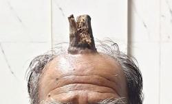 Aneh, di Kepala Pria India Ini Tumbuh Tanduk 10 Cm