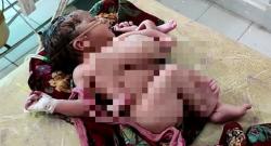 Miris, Bayi di India Lahir dengan 4 Kaki dan 3 Tangan