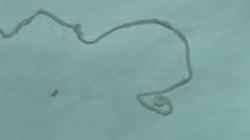 Cacing Pita Bersarang Selama 15 Tahun di Kepala Pria Ini, Gerogoti Otak