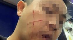 Polisi Hong Kong Disayat Pipinya Membentuk Tanda Silang