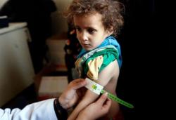 Amnesty: Jutaan Penyandang Disabilitas Paling Terdampak Perang Yaman