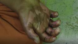 Korban Penyiksaan Ibu Tiri di Bandar Lampung Trauma, Keluarga Berharap Ada Terapi Mental