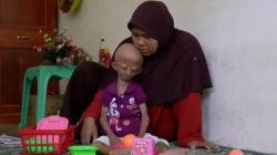 Kisah Giantika, Bocah 8 Tahun asal Aceh yang Alami Penuaan Dini karena Sindrom Progeria