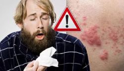 Gatal dan Kulit Kemerahan Jadi Tanda Baru Terinfeksi Virus Corona