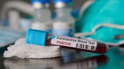 Pasien Positif Covid-19 di Sumut Bertambah 156 Orang, Berikut Sebarannya