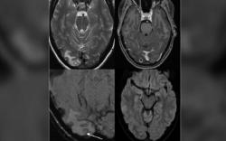 Sakit Kepala Selama 7 Tahun, Ada Larva Cacing Pita Bersarang di Otak Perempuan Ini