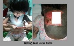 Kisah Haru Ratna Maya Bocah Penderita Kelainan Kulit asal Rembang<