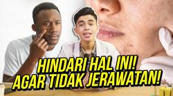 Ayman Alatas Kasih Tips untuk Terhindar dari Jerawat Membandel