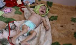 Miris, 400.000 Balita di Yaman Terancam Meninggal Tahun Ini karena Kelaparan