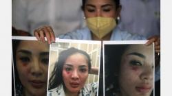 Ini Wajah Lebam Nindy Ayunda akibat KDRT, Ditunjukkan kepada Komnas Perempuan