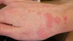 Puluhan Warga di Pontianak Diserang Gatal Scabies, Dinkes Gelar Pengobatan Massal