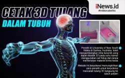 Infografis Cetak Tulang 3D di Dalam Tubuh