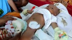 Bayi Tanpa Anus asal Pekalongan Butuh Bantuan untuk Biaya Operasi 