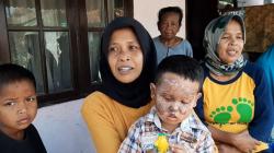 Main Petasan, Wajah Balita di Tasikmalaya Hangus Terbakar