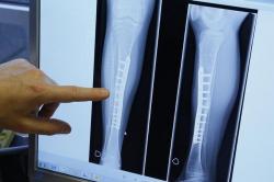 Lansia Bisa Cegah Osteoporosis dengan 5 Cara Ini, Salah Satunya Berhenti Merokok
