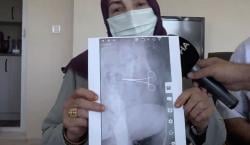 Ngeri, Gunting Bedah Tertinggal di Dalam Perut Perempuan Ini Pascaoperasi