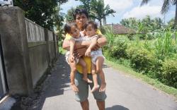 2 Tahun Menanti, Bayi Kembar Siam Inaya dan Anaya Operasi pada Agustus di Surabaya<